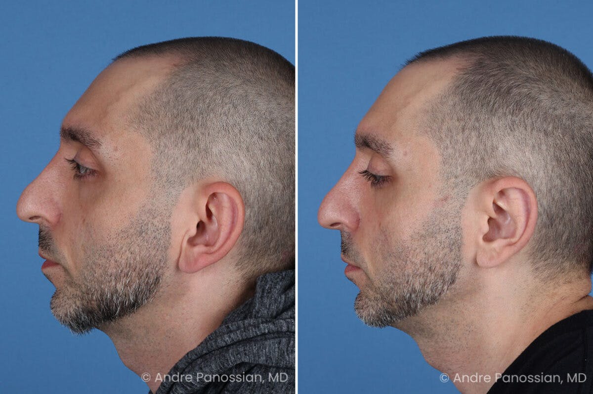Ear Pinning (Otoplasty) Before & After Gallery - Patient 349039 - Image 5