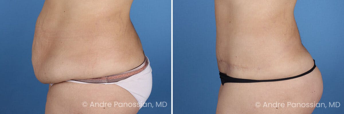 Tummy Tuck Before & After Gallery - Patient 466198 - Image 6