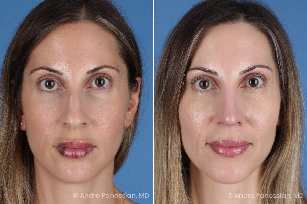Rhinoplasty Before & After Gallery - Patient 400190 - Image 2