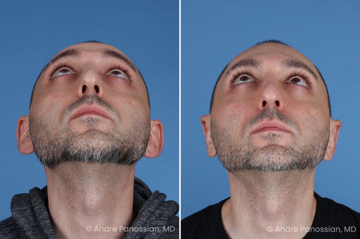 Ear Pinning (Otoplasty) Before & After Gallery - Patient 349039 - Image 6