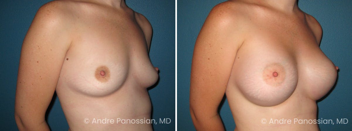 Breast Augmentation Before & After Gallery - Patient 314825 - Image 1