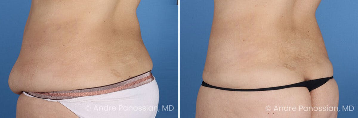 Tummy Tuck Before & After Gallery - Patient 466198 - Image 7