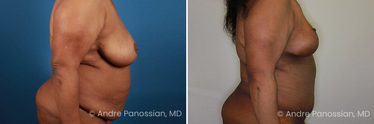 Breast Lift/Reduction Before & After Gallery - Patient 736829 - Image 3