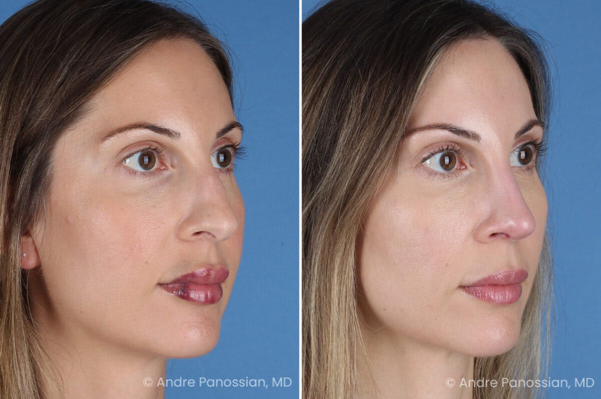 Rhinoplasty Before & After Gallery - Patient 400190 - Image 3