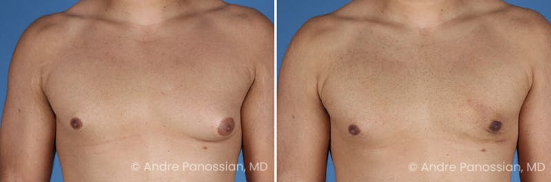 Male Breast Reduction (Gynecomastia) Before & After Gallery - Patient 414715 - Image 1