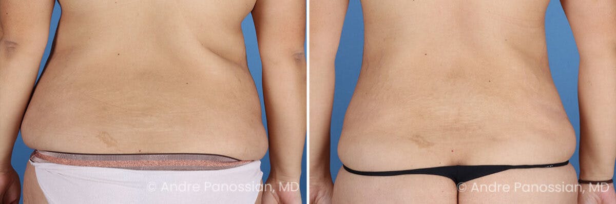 Tummy Tuck Before & After Gallery - Patient 466198 - Image 8