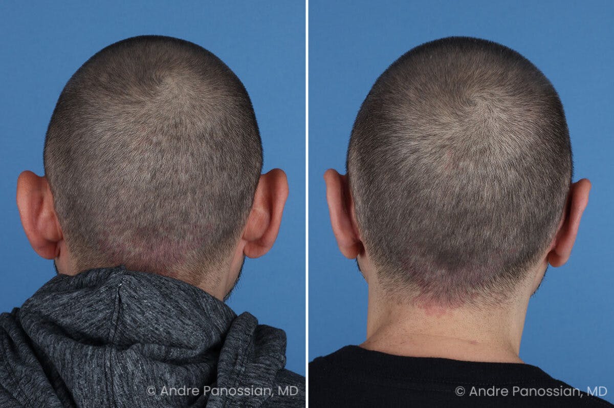Ear Pinning (Otoplasty) Before & After Gallery - Patient 349039 - Image 7