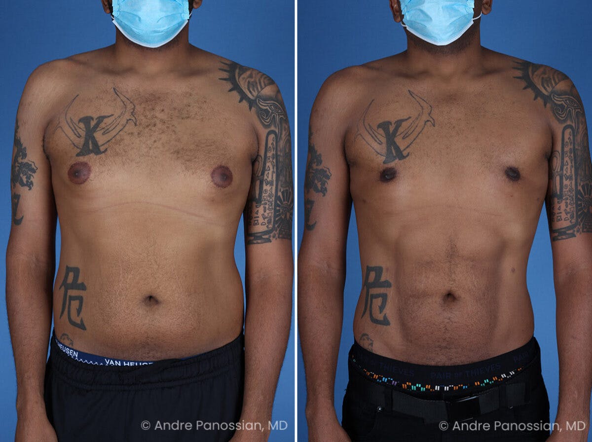 Abdominal High-Definition Liposuction Before & After Gallery - Patient 396422 - Image 1