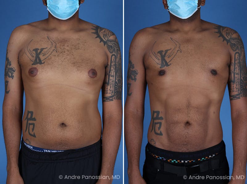 Abdominal High-Definition Liposuction Before & After Gallery - Patient 396422 - Image 1
