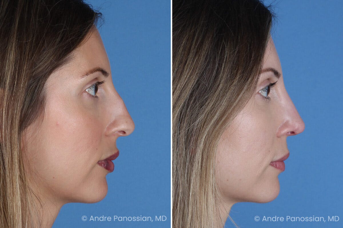 Rhinoplasty Before & After Gallery - Patient 400190 - Image 1