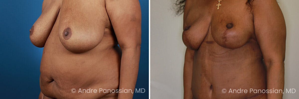 Breast Lift/Reduction Before & After Gallery - Patient 736829 - Image 4