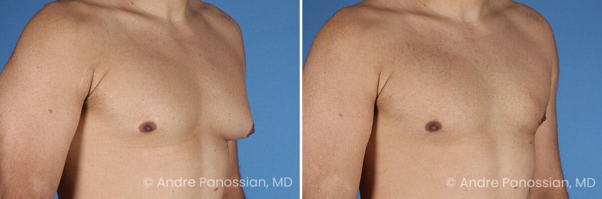 Male Breast Reduction (Gynecomastia) Before & After Gallery - Patient 414715 - Image 2