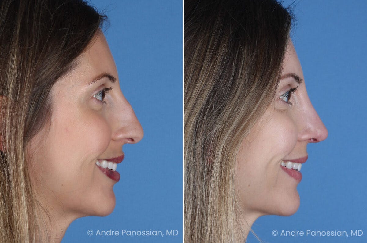 Rhinoplasty Before & After Gallery - Patient 400190 - Image 4