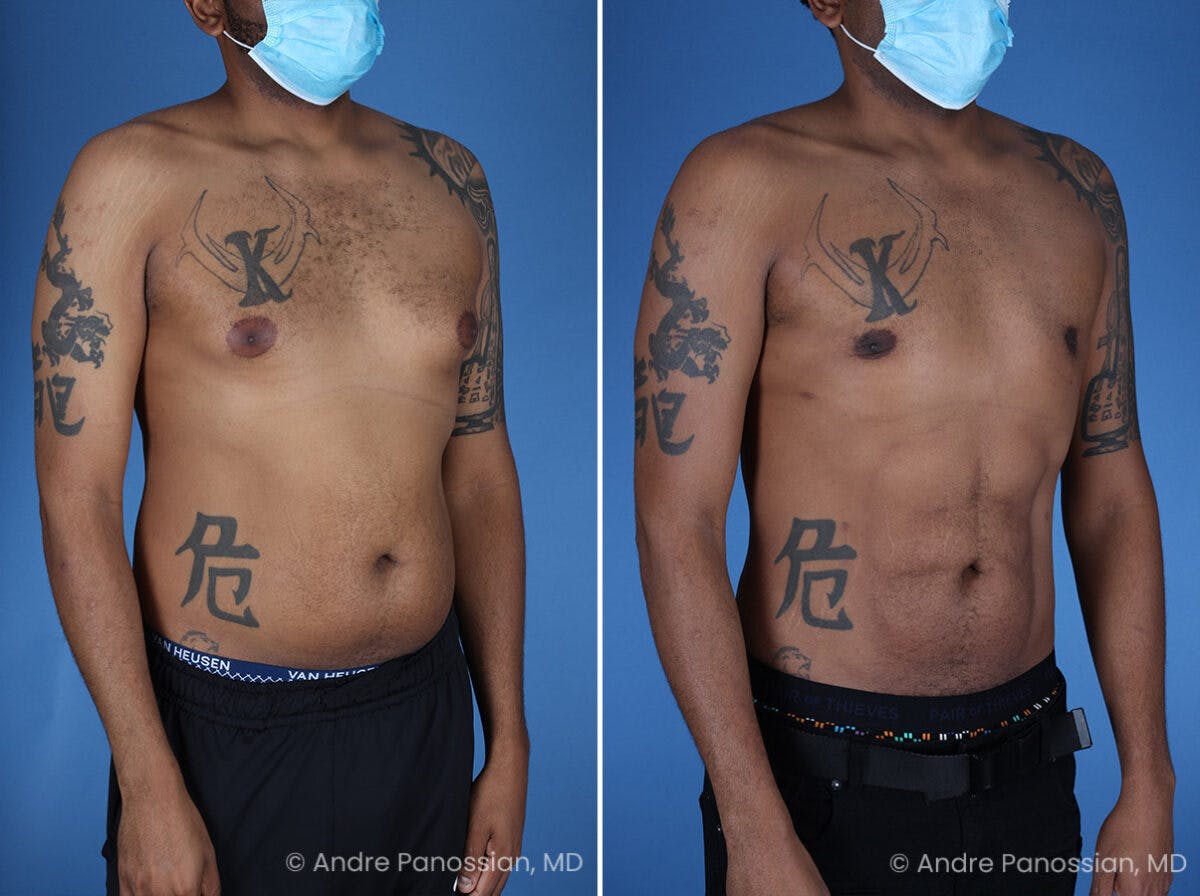 Abdominal High-Definition Liposuction Before & After Gallery - Patient 396422 - Image 2