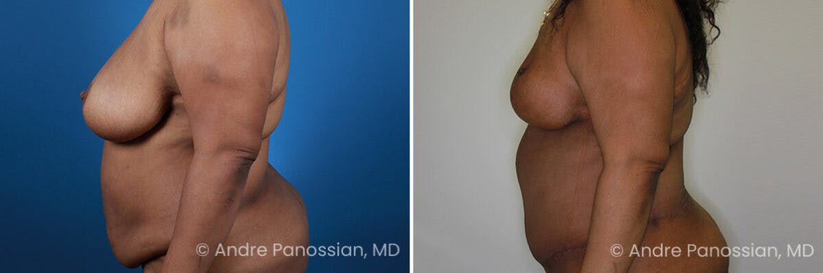 Breast Lift/Reduction Before & After Gallery - Patient 736829 - Image 5