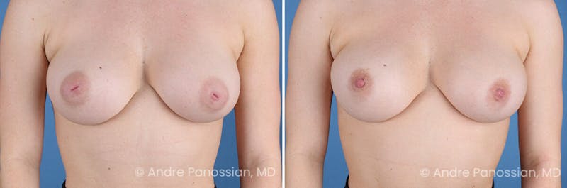Inverted Nipple Correction Before & After Gallery - Patient 252740 - Image 1