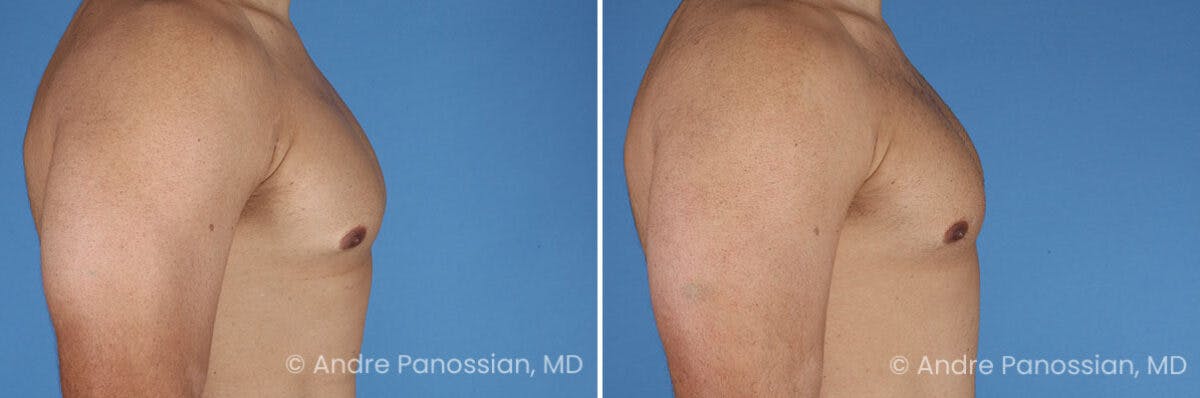 Male Breast Reduction (Gynecomastia) Before & After Gallery - Patient 414715 - Image 3