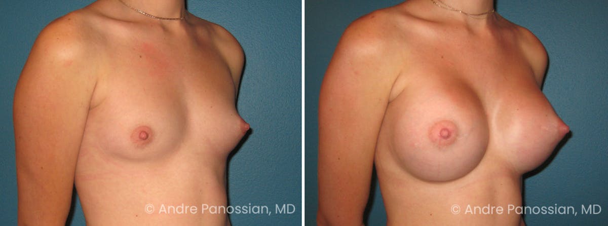 Breast Augmentation Before & After Gallery - Patient 149122 - Image 1