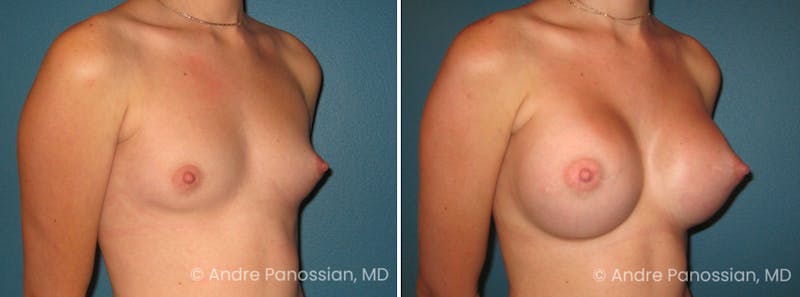 Breast Augmentation Before & After Gallery - Patient 149122 - Image 1