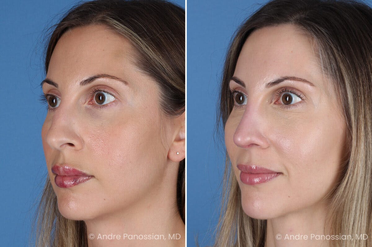 Rhinoplasty Before & After Gallery - Patient 400190 - Image 5