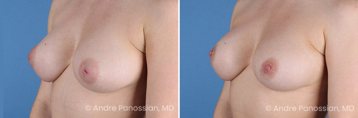 Inverted Nipple Correction Before & After Gallery - Patient 252740 - Image 2