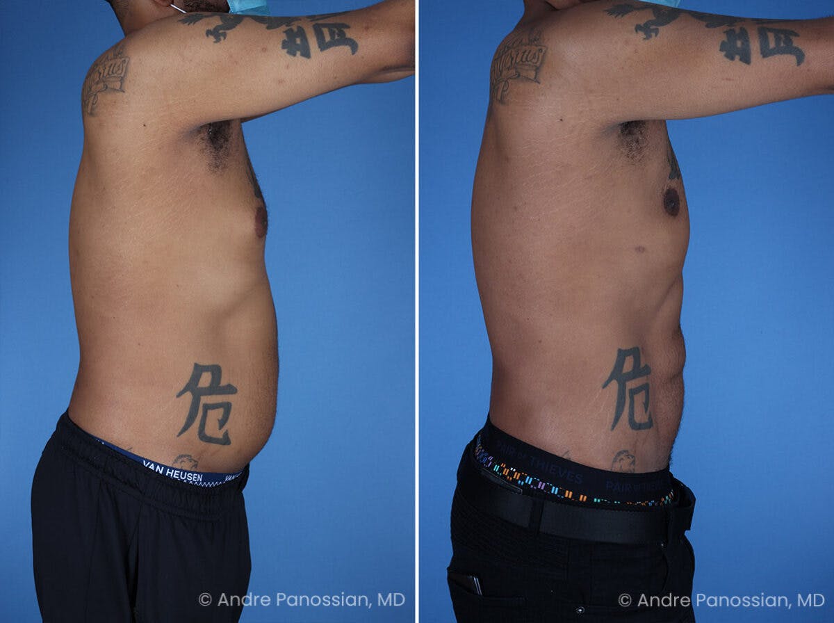 Abdominal High-Definition Liposuction Before & After Gallery - Patient 396422 - Image 3