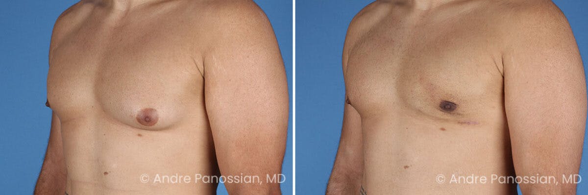 Male Breast Reduction (Gynecomastia) Before & After Gallery - Patient 414715 - Image 4