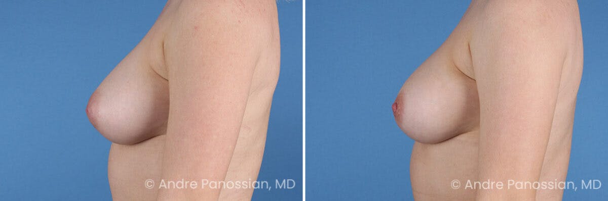 Inverted Nipple Correction Before & After Gallery - Patient 252740 - Image 3