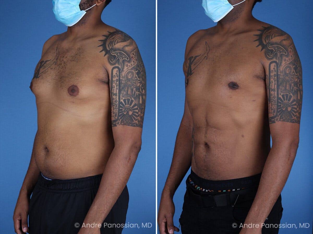 Abdominal High-Definition Liposuction Before & After Gallery - Patient 396422 - Image 4