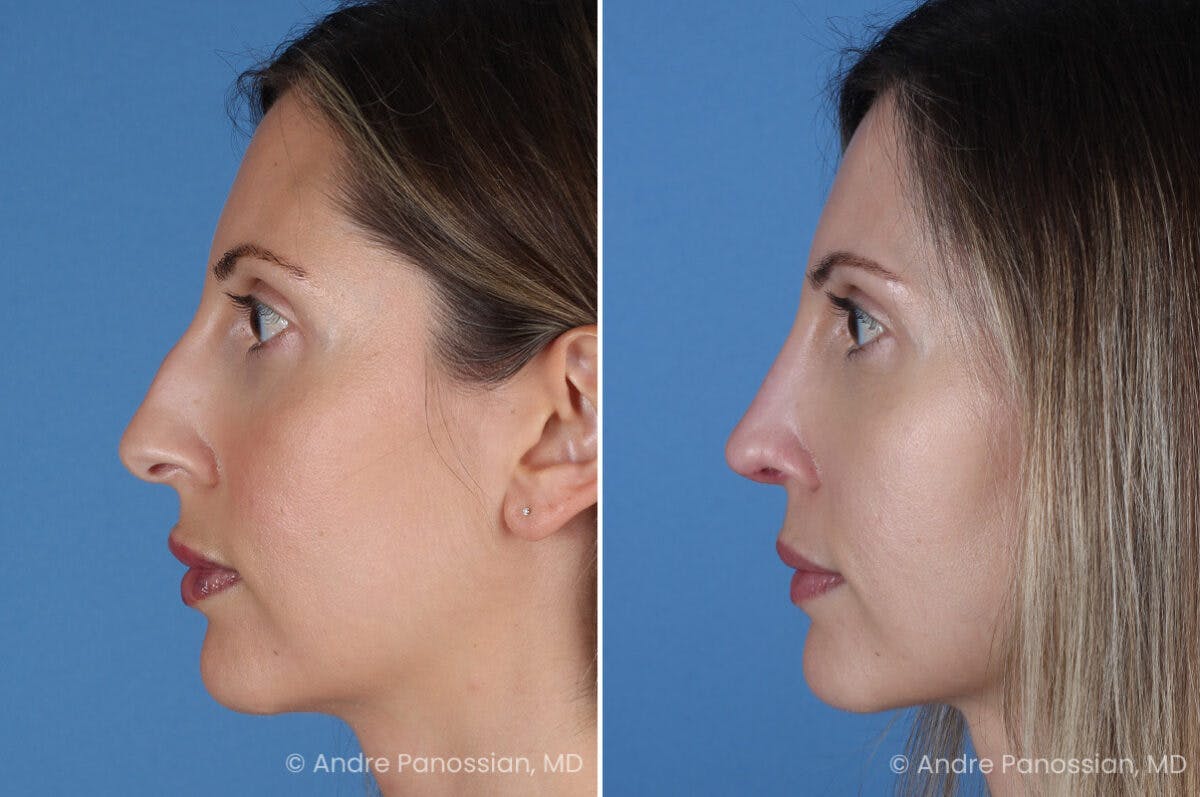 Rhinoplasty Before & After Gallery - Patient 400190 - Image 6