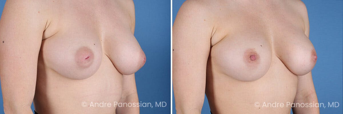 Inverted Nipple Correction Before & After Gallery - Patient 252740 - Image 4