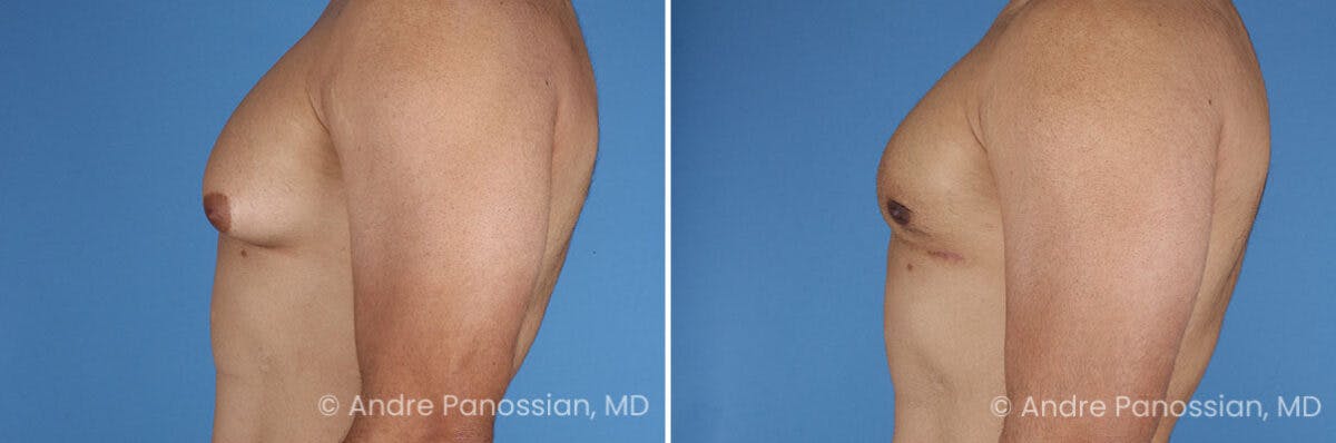 Male Breast Reduction (Gynecomastia) Before & After Gallery - Patient 414715 - Image 5
