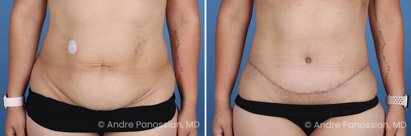 Tummy Tuck Before & After Gallery - Patient 319524 - Image 1