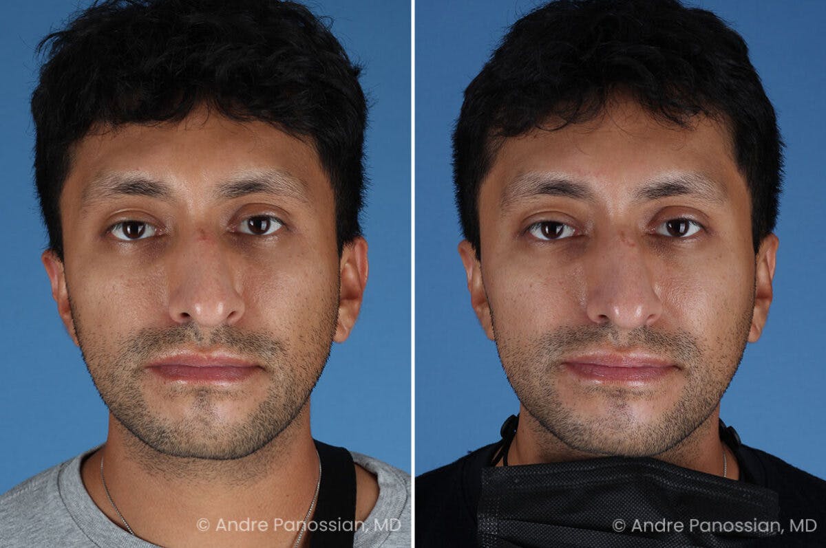 Ear Pinning (Otoplasty) Before & After Gallery - Patient 209648 - Image 1