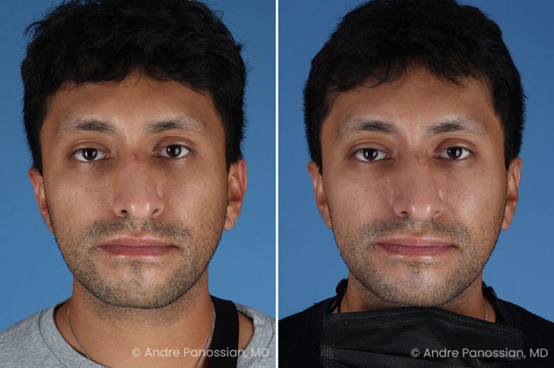 Ear Pinning (Otoplasty) Before & After Gallery - Patient 209648 - Image 1