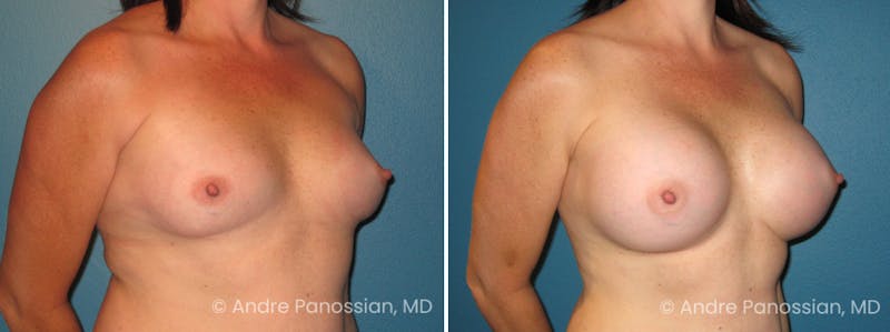 Breast Augmentation Before & After Gallery - Patient 153265 - Image 1