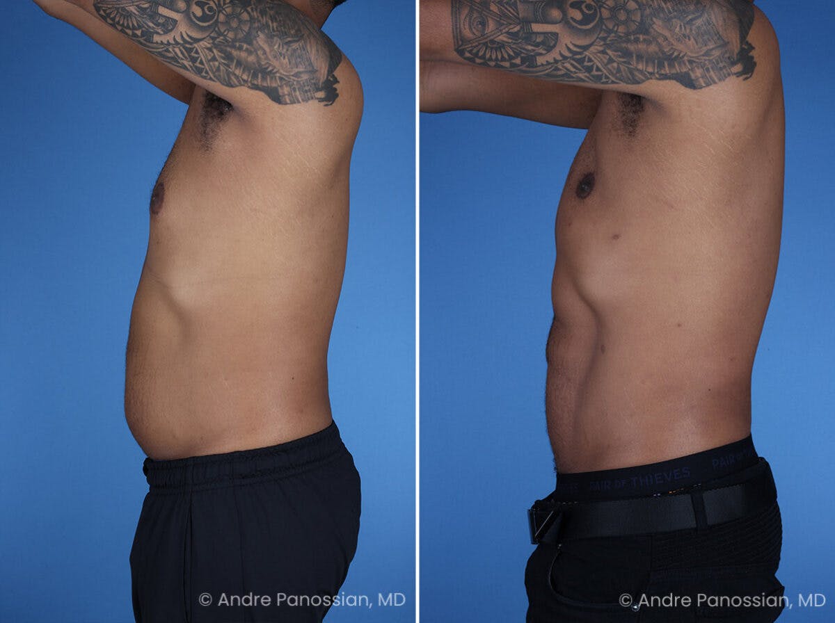 Abdominal High-Definition Liposuction Before & After Gallery - Patient 396422 - Image 5