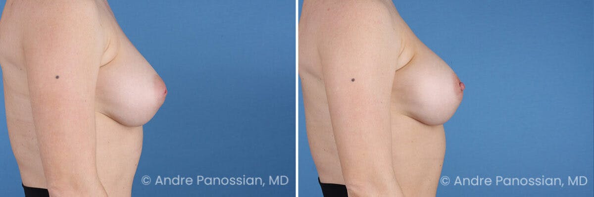 Inverted Nipple Correction Before & After Gallery - Patient 252740 - Image 5