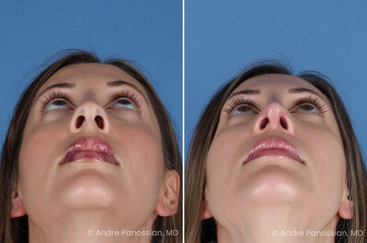 Rhinoplasty Before & After Gallery - Patient 400190 - Image 8