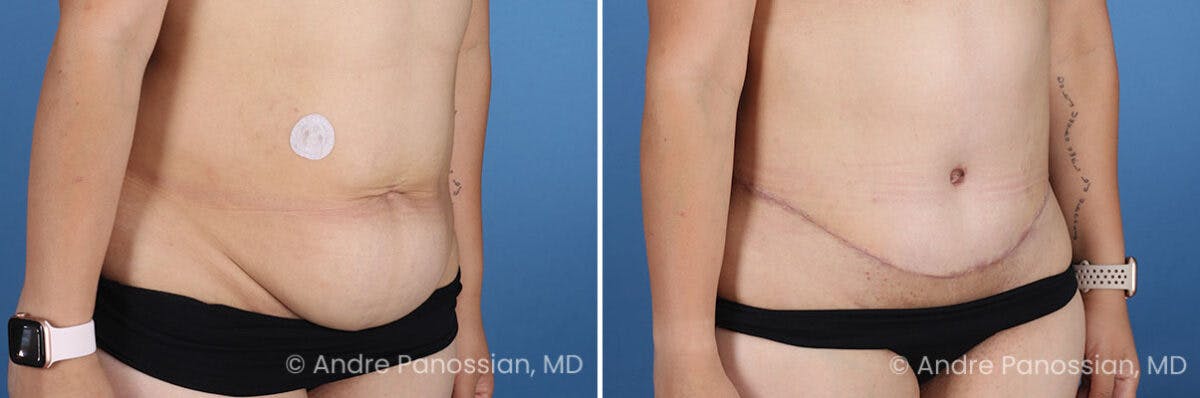 Tummy Tuck Before & After Gallery - Patient 319524 - Image 2