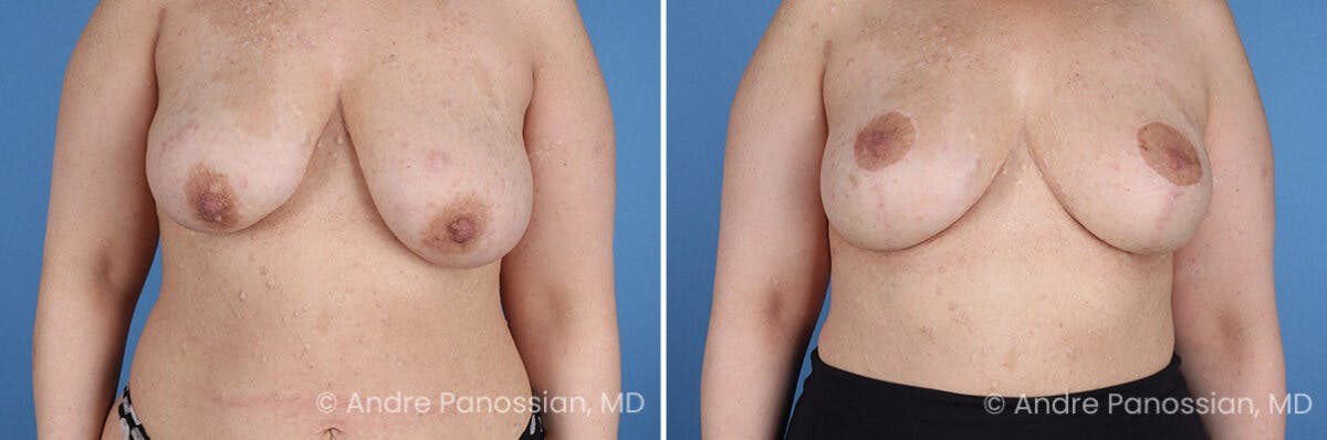 Breast Lift/Reduction Before & After Gallery - Patient 598214 - Image 1