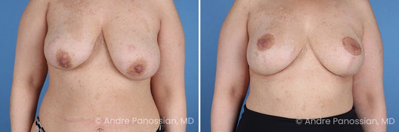 Breast Lift/Reduction Before & After Gallery - Patient 598214 - Image 1