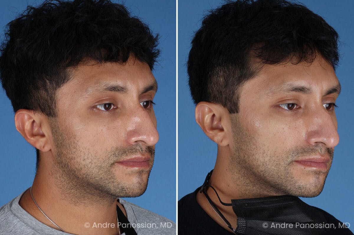 Ear Pinning (Otoplasty) Before & After Gallery - Patient 209648 - Image 2