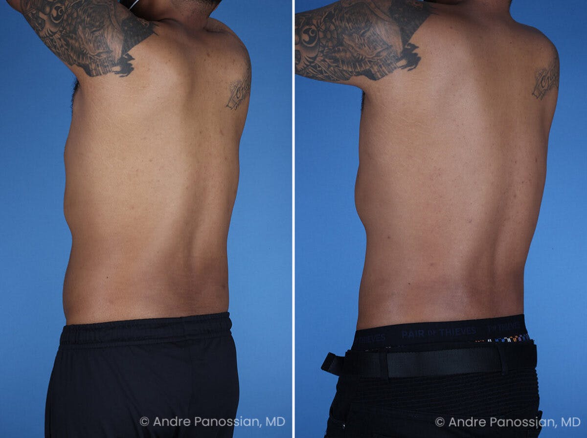 Abdominal High-Definition Liposuction Before & After Gallery - Patient 396422 - Image 6
