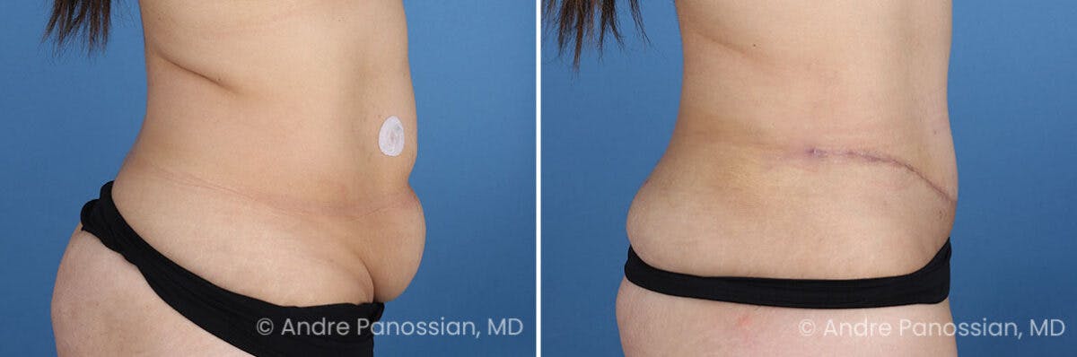 Tummy Tuck Before & After Gallery - Patient 319524 - Image 3