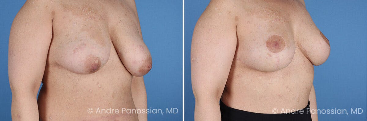Breast Lift/Reduction Before & After Gallery - Patient 598214 - Image 2