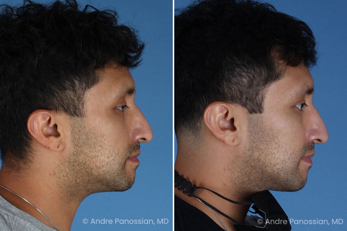 Ear Pinning (Otoplasty) Before & After Gallery - Patient 209648 - Image 3