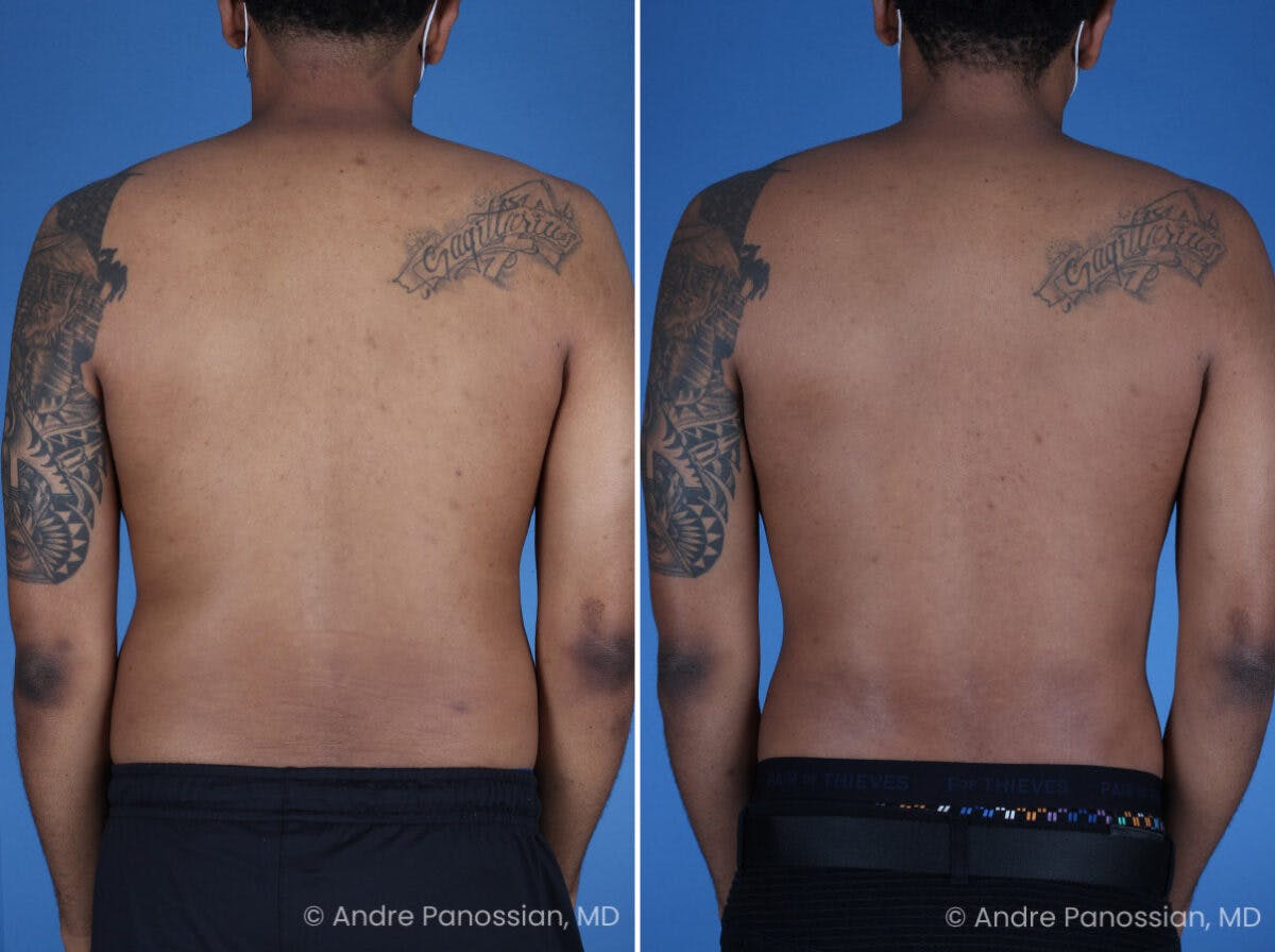 Abdominal High-Definition Liposuction Before & After Gallery - Patient 396422 - Image 7