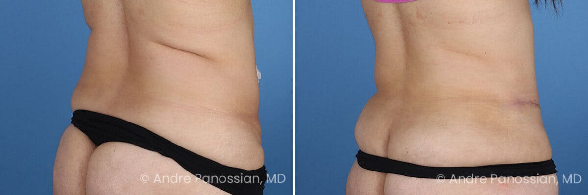 Tummy Tuck Before & After Gallery - Patient 319524 - Image 4