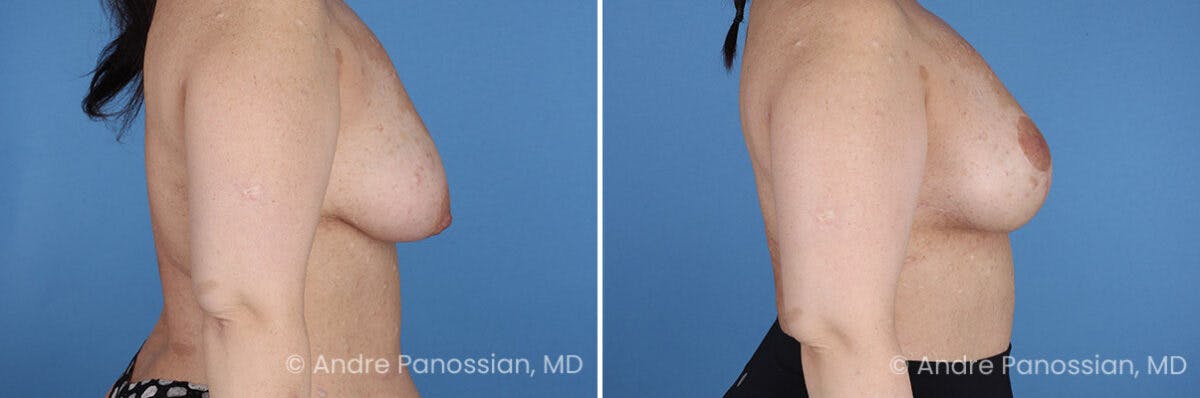 Breast Lift/Reduction Before & After Gallery - Patient 598214 - Image 3